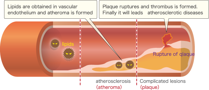 Mechanism of arteriosclerosis