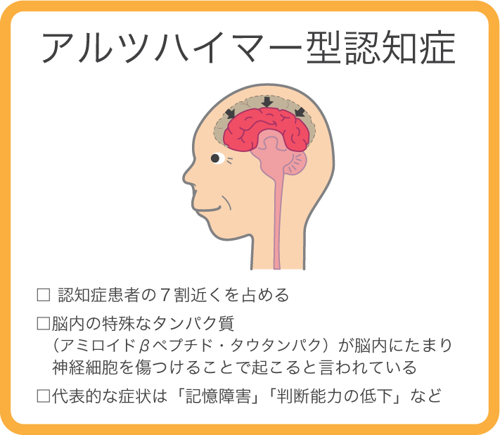 アルツハイマー 型 認知 症